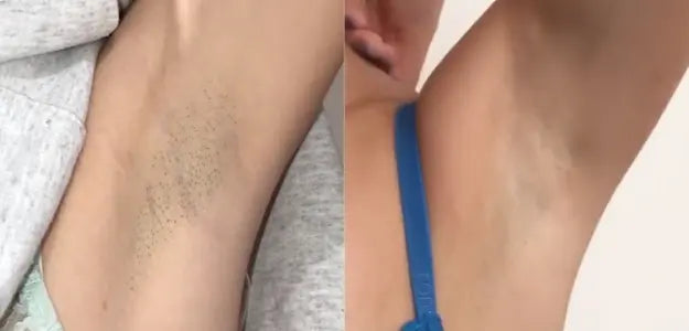 BlastLaser : “Explosive power for flawless skin.”