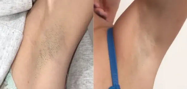 Sublime Laser Results